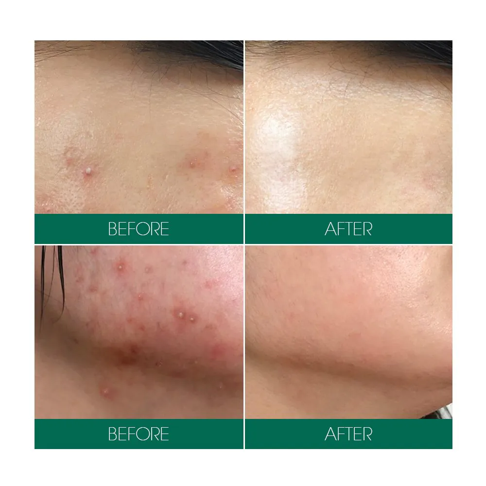 تونر-ميركل-لعلاج-حب-الشباب-ومشاكل-البشرة-تحدي-ال30-يوم-SomeByMi-AHA-BHA-PHA-30-Days-Miracle-Toner-150ml-(5oz)-Anti-acne-Exfoliation-Hydration-Brightening