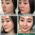تونر-ميركل-لعلاج-حب-الشباب-ومشاكل-البشرة-تحدي-ال30-يوم-SomeByMi-AHA-BHA-PHA-30-Days-Miracle-Toner-150ml-(5oz)-Anti-acne-Exfoliation-Hydration-Brightening
