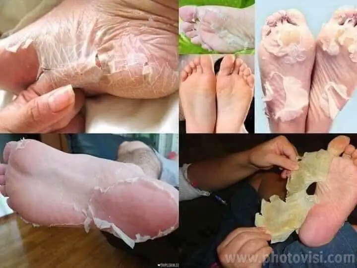 ماسك-تقشير-القدم-الكوري-من-بيور-ديرم–purederm-exfoliating-foot-mask-Peels-Away-Calluses-And-Dead-Skin-(23 (1)