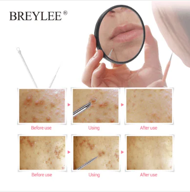 ابرة ازالة وتنظيف المسام والرؤوس السوداء والتخلص من البثور والحبوب 2في1 Acne Removal Needle Tools (2)