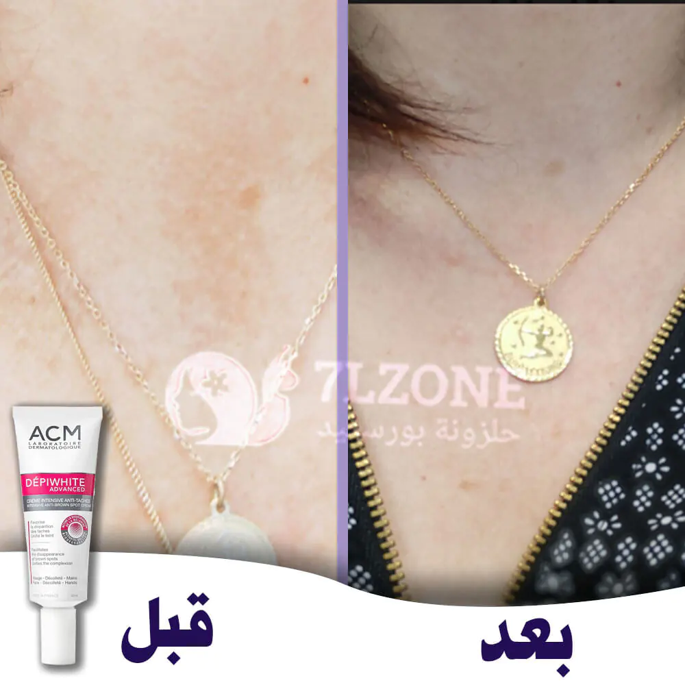 depiwhite-advanced-cream-before-and-after-سنسوما ديبي وايت