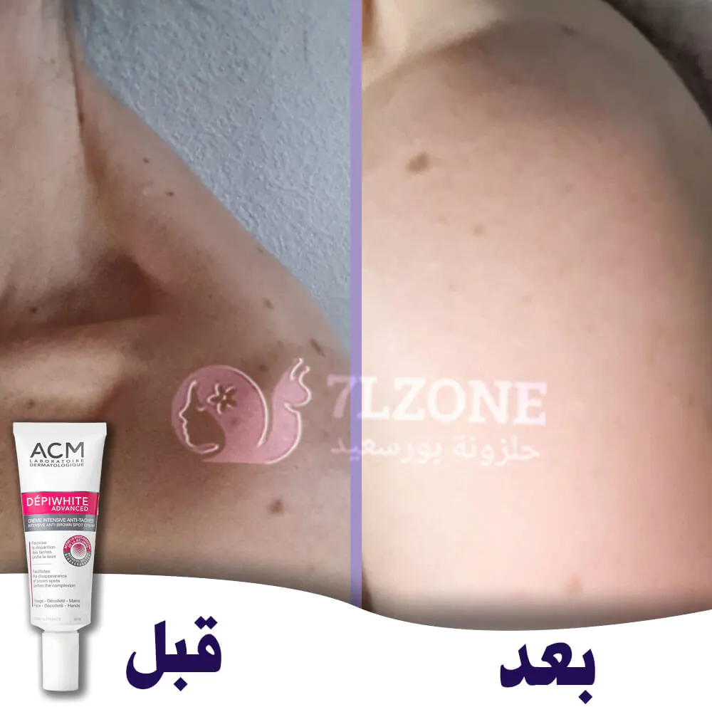 depiwhite-advanced-cream-before-and-after-ماتيلدا acm depiwhite سعر