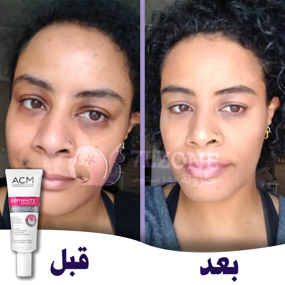 depiwhite-advanced-cream-before-and-after acm depiwhite advanced cream review